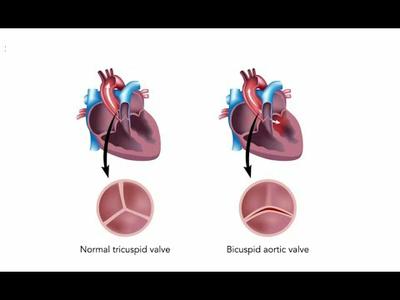 On-X Patient Interview:  Fred Hoiberg talkes about his On-X Aortic Valve vs. other Mechanical Valves