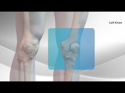All-Inside ACL Reconstruction with Arthrex® GraftLink®