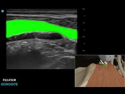 3D Video: Quadratus Lumborum Block