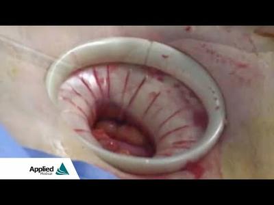 Laparoscopic Colectomy featuring the Alexis® O Protector-Retractor