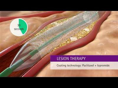 SeQuent® Please NEO: The implant-free alternative for treating coronary artery disease