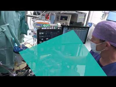 First case with the Essenz Perfusion System
