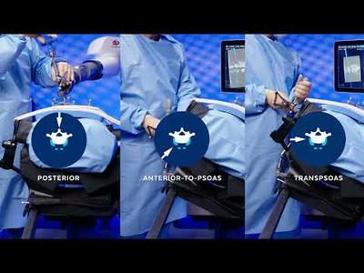Simultaneous Access to Direct & Indirect Decompression:  Excelsius® Prone Lateral Surgical Solution